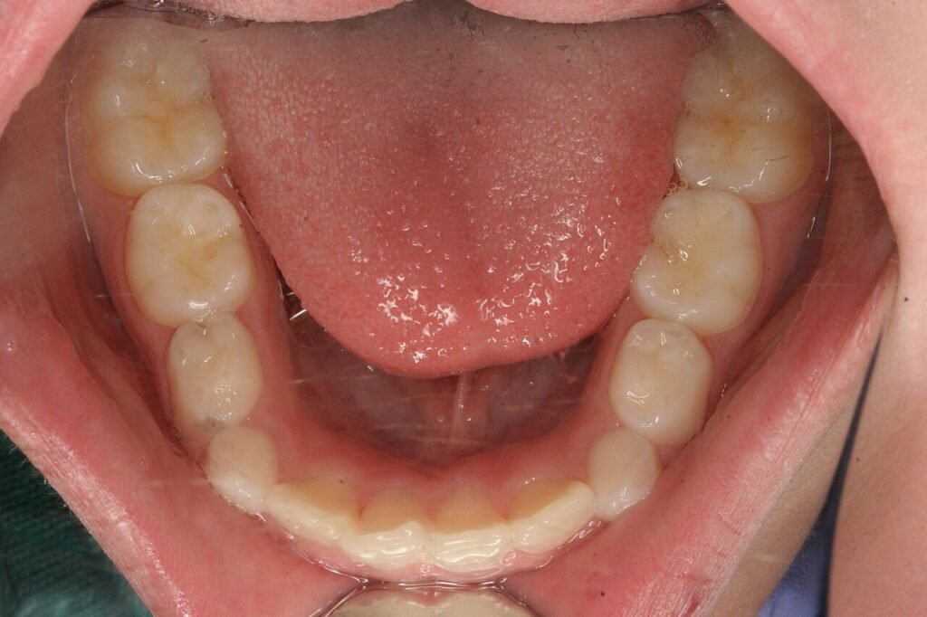Dentición mixta infantil en una revisión de ortodoncia temprana