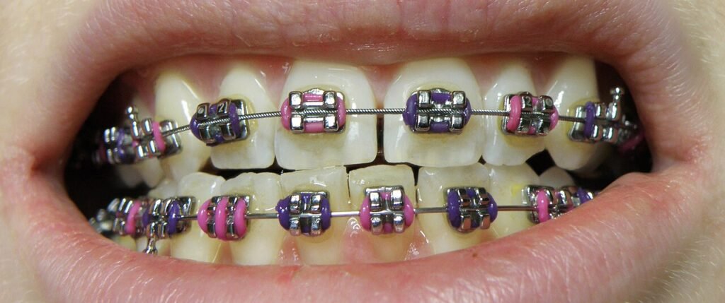 Aparato de ortodoncia con brackets en arcada superior e inferior para alinear dientes y mordida