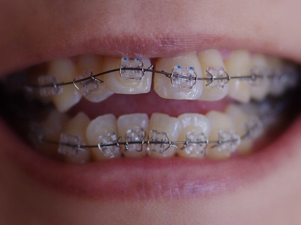 Sonrisa con brackets metálicos durante tratamiento de ortodoncia