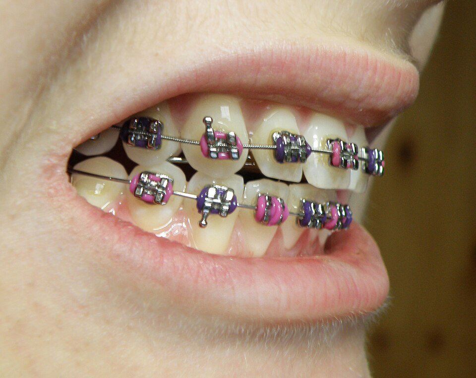Paciente con brackets de ortodoncia en vista lateral
