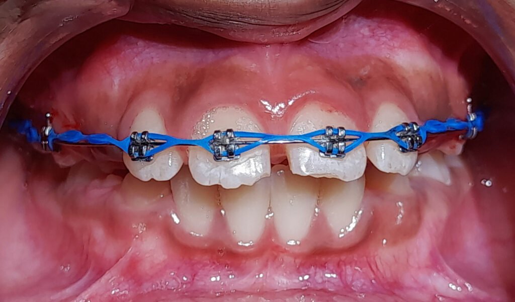 Brackets de ortodoncia colocados sobre dientes como imagen destacada de una guía dental