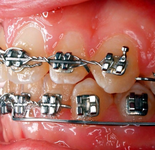 Brackets metálicos de ortodoncia colocados sobre dientes