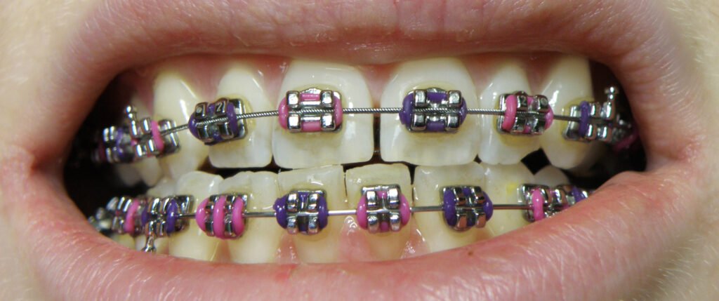 Brackets metálicos en arcada superior e inferior durante un tratamiento de ortodoncia