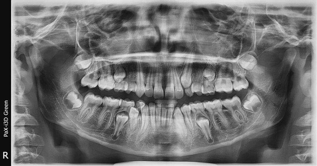 Radiografía panorámica de dentición mixta útil para valorar el momento de una ortodoncia